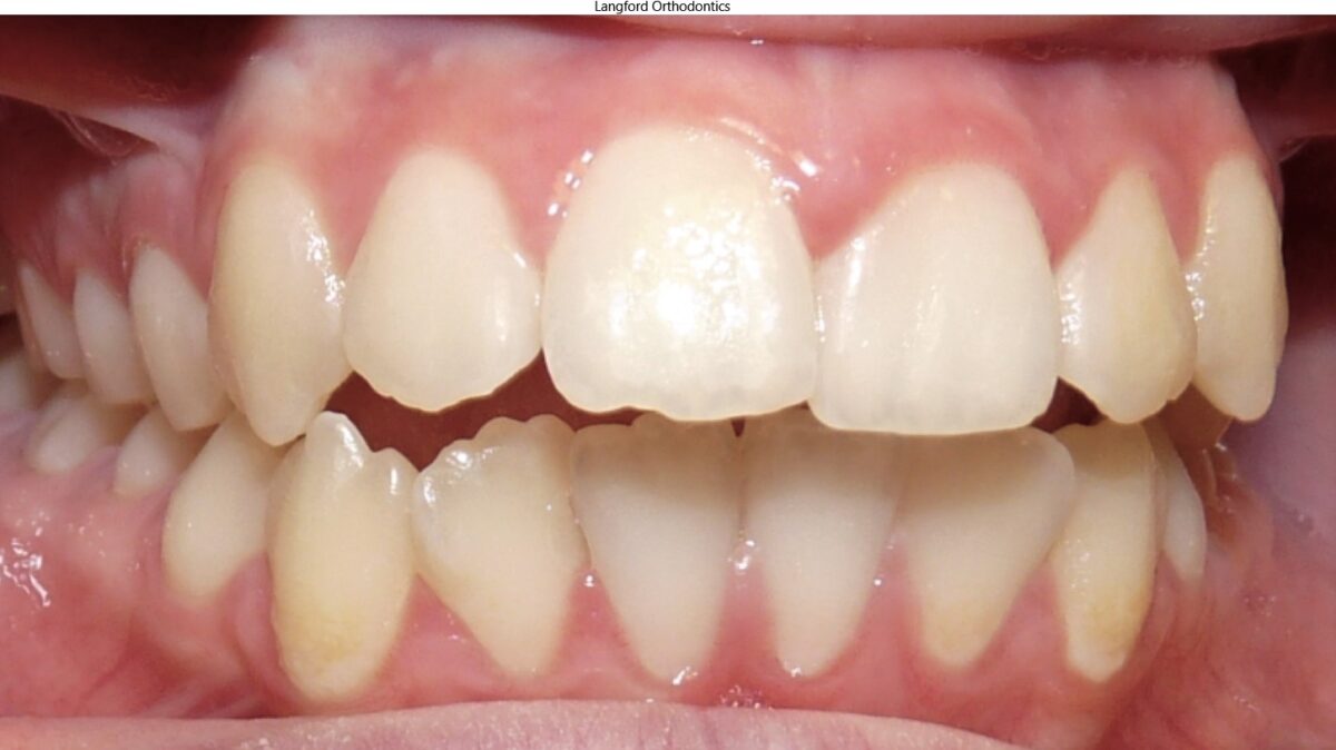 Orthodontics Before & Afters in Knoxville & Seymour, TN