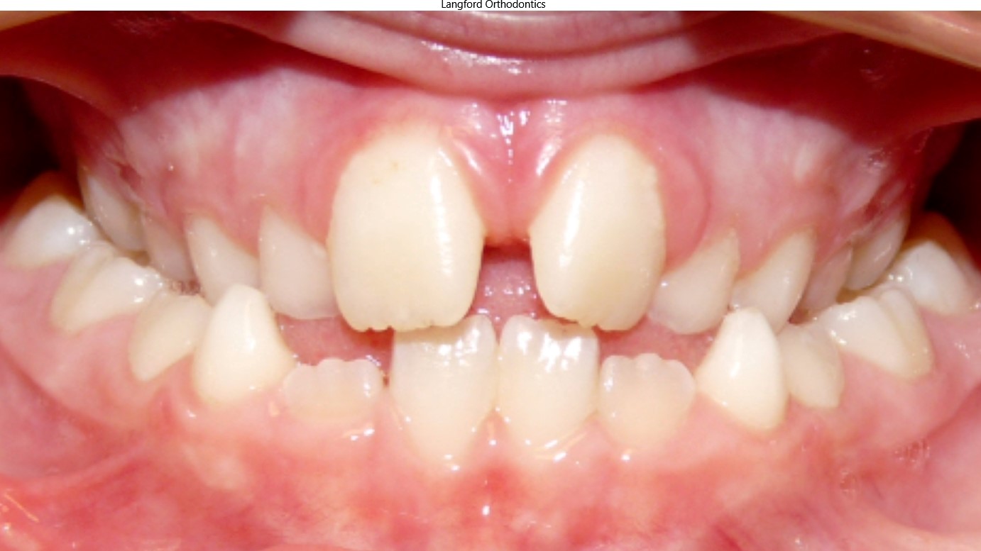 Orthodontics Before & Afters in Knoxville & Seymour, TN