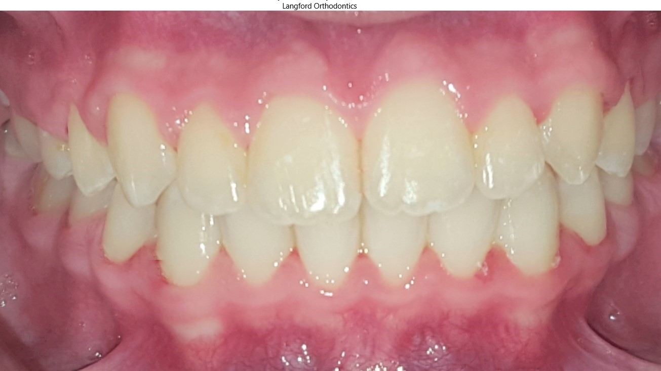 Orthodontics Before & Afters in Knoxville & Seymour, TN